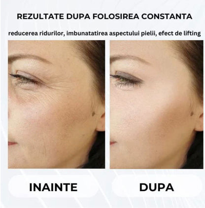 Instrument de infrumusetare pentru lifting facial
